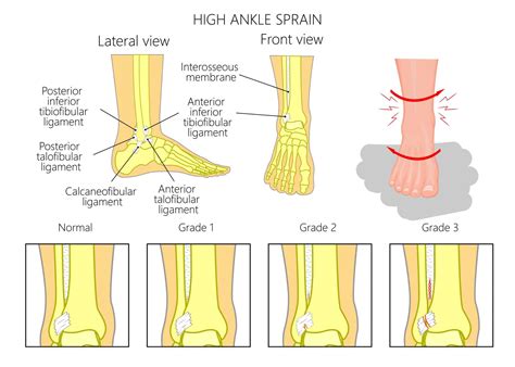 sprained ankle deutsch